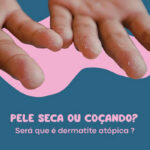 Pele seca cocando dermatite atopica 150x150