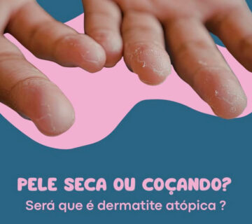 Pele seca cocando dermatite atopica 360x320